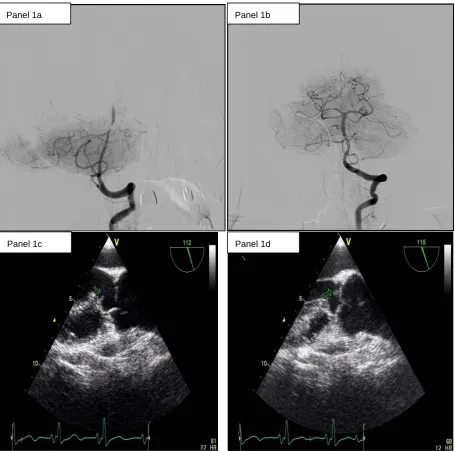 Figure 1. thrombectomy and stenting. Despite a residual stenosis, a complete anterograde flow is noted