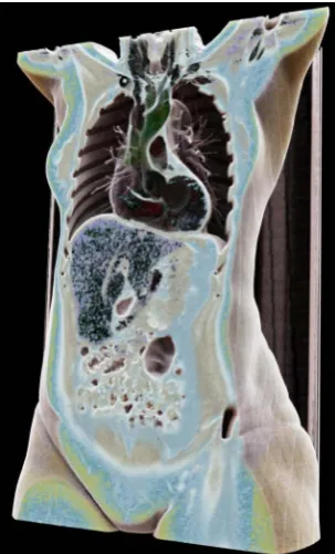 Figure 3. The same whole-body CT scan as in Figure 2; in this case, the bones, blood vessels and kidneys are visualized, and once again, a significantly more realistic depiction of the above-named anatomical structures is provided by Cinematic Rendering (b