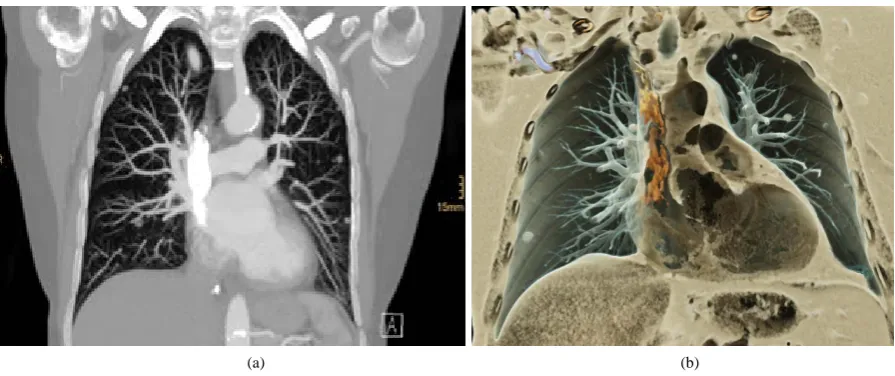 Figure 5. Comparison of Maximum Intensity Projection (MIP) (a) and Cinematic Rendering (b) of a contrast-enhanced computed tomography scan of the chest visualizing multiple pulmonary nodules