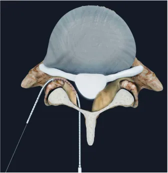 Figure 3 After the probe has been properly inserted and the wire has been delivered, the iO-Flex® MicroBlade Shaver® is passed through the epidural space and out of the lateral foramen.Note: Tissue is removed using a bimanual reciprocating motion.