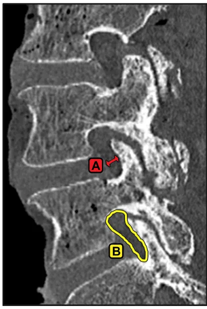 Figure 4 Preoperative and postoperative assessment of decompression using fluoroscopy and a Woodson probe (lateral images [left to right]: pretreatment with MicroBlade Shaver® instrument, post-treatment with MicroBlade Shaver instrument, and post-treatment assessment with Woodson probe).