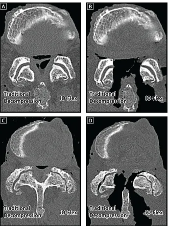 Figure 7 Reconstructed axial computed tomography scans illustrating the ability of the iO-Flex® system to decompress the lateral recess and foramen effectively while maintaining facet joint integrity