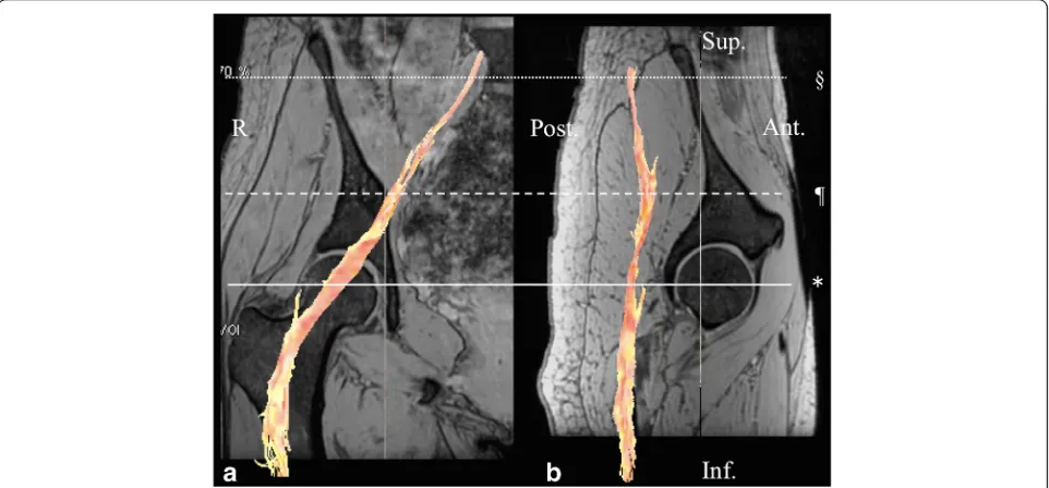 Fig. 1 A fusion image of diffusion tensor tractography of the sciatic nerve with multiple echo recombined gradient echo imaging.section of the femoral head in the right hip showing the sciatic nerve fibers from the S1 to the proximal femur in orange