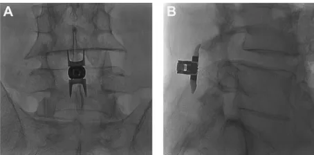 Figure 1 (A) Postero-anterior and (B) lateral radiographic images showing a properly placed Superion® Interspinous Spacer (VertiFlex, Inc, San Clemente, CA).