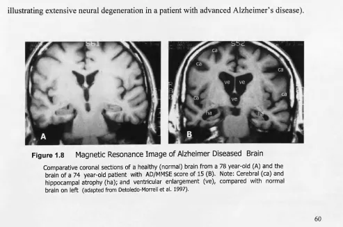 Figure 1.8 Magnetic Resonance Image of Alzheimer Diseased BrainComparative coronal sections of a healthy (normal) brain from a 78 year-old (A) and the 
