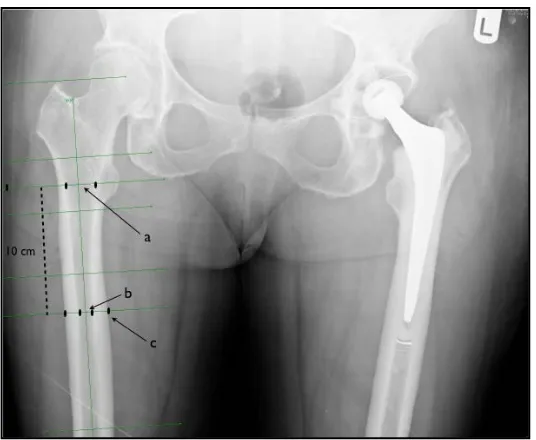 Figure 1. Plain radiograph of both hips, A-P view. a: Medullary canal width at he level of the geometric centre of LT