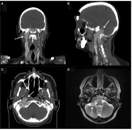 Figure 7Glomus jugulare tumour. Coronal (A), sagittal (B) and axial (C) images from a contrast-enhanced CT scandemonstrate a bilobed, expansile, hypervascular mass (white arrows) within the right base of the skull extending throughthe jugular foramen into 