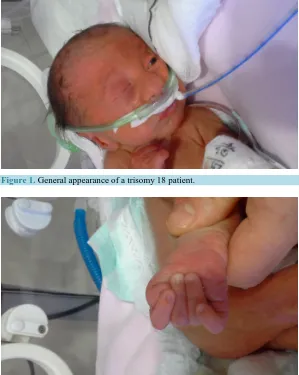 Figure 1. General appearance of a trisomy 18 patient. 