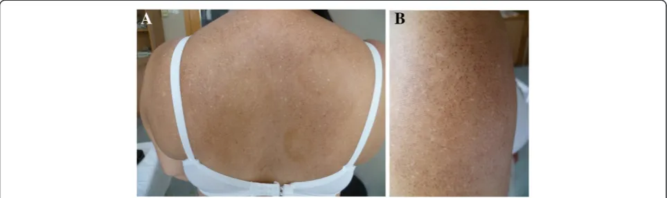 Figure 2 Clinical presentation of amyloidosis cutis dyschromica. In addition to the hyper- and hypopigmented macules, diffusehyperpigmented small papules were noted (patient 4).