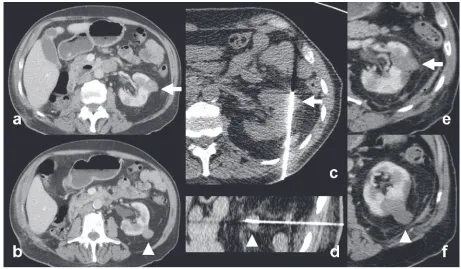 Figure 2 Example of radiofrequency ablation of renal cell carcinoma. (cell carcinoma (RCC) 5 years ago) presented with 2 small exophytic renal tumors (white arrow and arrowhead)