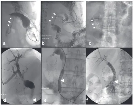Figure 3 Example of combined gastroduodenal and biliary stenting. (the duodenum (white arrows)