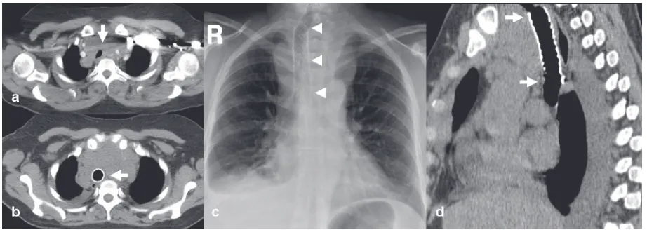 Figure 4 Example of palliative tracheal stenting. (displacing the trachea (white arrow)