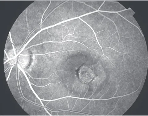 Figure 3b Early arteriovenous phase fluorescein angiogram demonstrating early central hyperfluorescence of the choroidal neovascularization