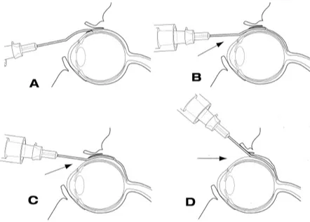 Figure 5 Technique of posterior juxtascleral depot injection involves the introduction of cannula into the subconjunctival/subtenon’s space and subsequentadvancement behind and adjacent to globe.