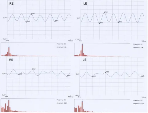 Table 3 Steady-State Pattern Electroretinogram (SS-PERG) Amplitude Values of the Right Eye (RE) and Left eye (LE) in Dyslexics andControl Subjects