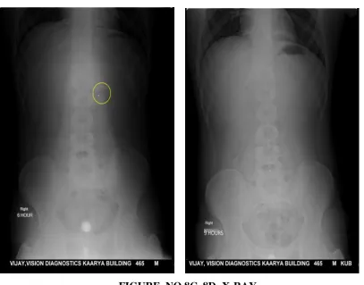 FIGURE .NO 8A, 8B -X-RAY 
