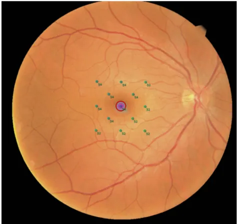 Figure 1 Real example of microperimetry performed for the study in a right eye.Microperimetric results of the right eye of a healthy subject