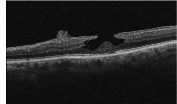 Figure 1 Optical coherence tomography of a tractional lamellar macular hole, characterized by epiretinal membrane with surface wrinkling, sharp intraretinal split, and“schisis-like” appearance.