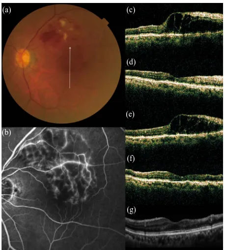 Figure 3. No recurrence of macular edema after grid pho- for recurrent macular edema associated with BRVO