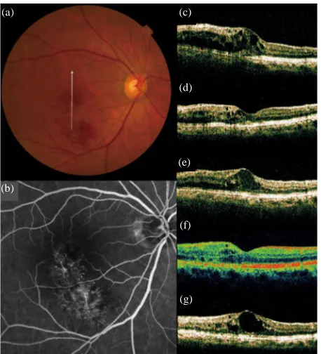 Figure 4. Recurrence of macular edema after grid photo- coagulation combined with IVB for recurrent macular edema associated with BRVO