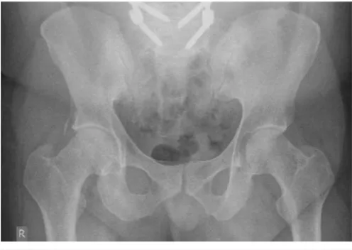 Figure 1. X-ray of left hip.                                        