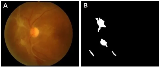 Figure 6 an example result of hard exudate and cotton-wool spot detection: (A) original image and (B) result image.