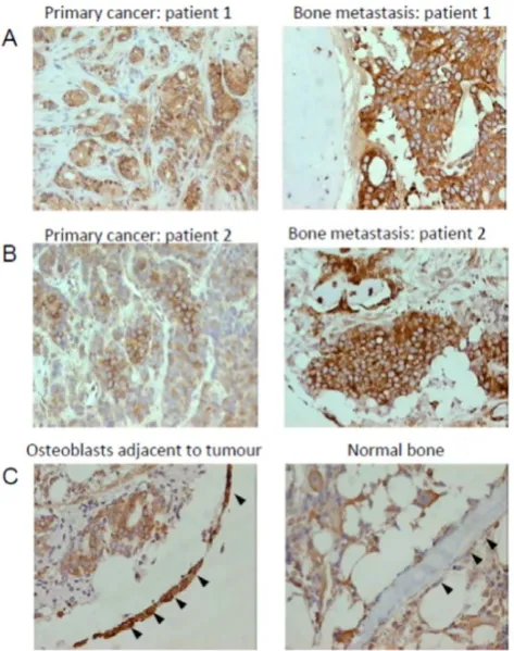 Figure 3. Representative images showing the immunoexpres-sion of eEF1A1 in prostatic tissue, bone metastatic lesions andwhereas osteoblasts lining normal bone show weak expression(staining intensity = 1,control bone