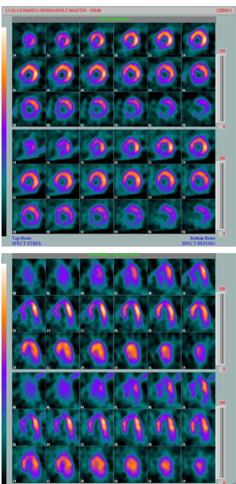 Figure 1. Septal and inferior defects (white arrow). 