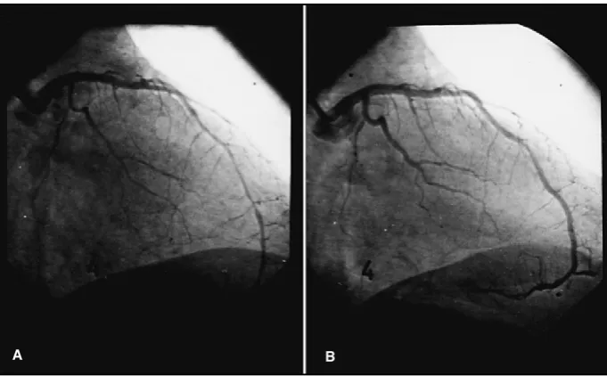 Figure 2. Abnormal vasomotor response in the anterior descending artery alter maximum dose acetylcholine infusion (10−4 mol/l) (A) with ulterior recovery of the luminal diameter (B)