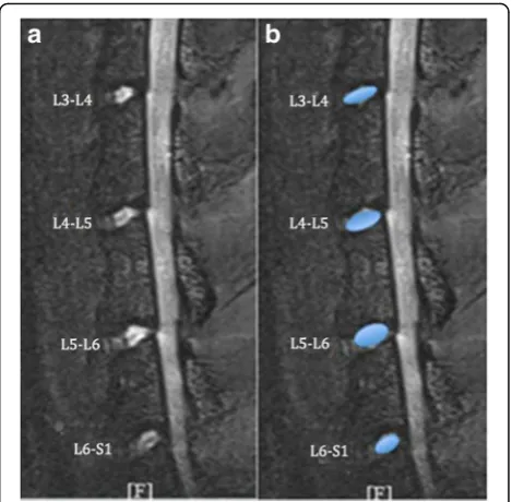 Fig. 1 Computer screen captures showing a raw, T2-weighted magneticresonance image of a rat lumbar spine (a) and the same image with NPoutlined to define ROI (b).The measured NP area and signal intensity areshown (L3–L4 represent the intervertebral disc between the third andthe fourth lumbar vertebra, and so on)