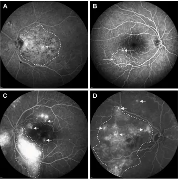 Figure 4 Four categories of eyes with severe chronic central serous chorioretinopathy with active fluorescein leakage on fluorescein angiography.Notes: This figure illustrates different fluorescein leakage locations (arrows) in relation to the largest area