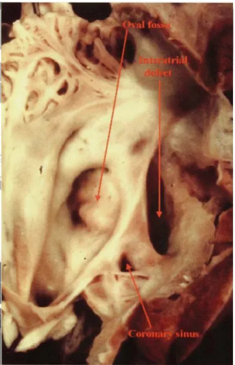 Figure 16.Thispermittingatrialinteratrial communication is an atrioventricular septal defect shows the essence of the "ostium primum" defect