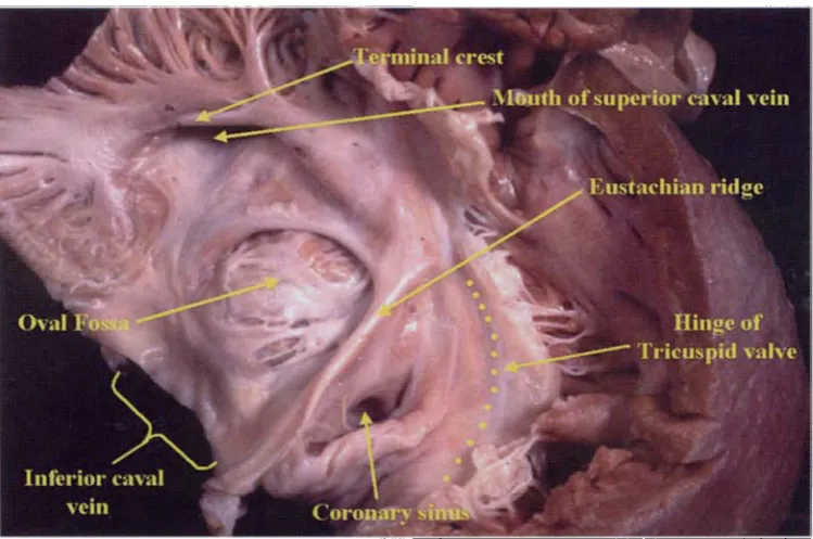 Figure 1.The right atrium has been