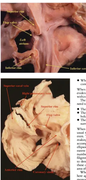 Figure 5.This adult heart has been dissected to show the structure of the ovalfossa. The thin flap valve is anchored on the firm anterior rim, heresectioned at the point where it becomes contiguous with the aorticmound