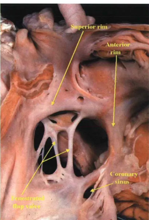 Figure 6.This specimen shows a smallsuperior rim. This would be anelliptical defectmargin of the deficient flap valveof the oval fossa and the infolded between the upperideal case for device closure.