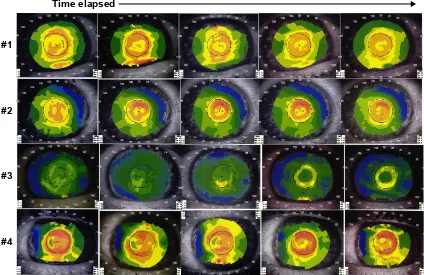 Figure 6 longitudinal corneal topographic changes associated with Mrse changes in a single patient
