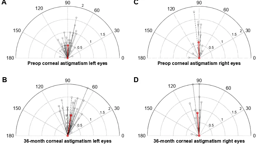 Figure 8 Depictions of corneal astigmatisms and axis for left and right eyes in vector format.Notes: (A) red line shows mean corneal astigmatism in corresponding axis preoperatively for left eyes; (B) red line shows mean corneal astigmatism in corresponding axis at 36 months postoperatively for left eyes; (C) red line shows mean corneal astigmatism in corresponding axis preoperatively for right eyes; (D) red line shows mean corneal astigmatism in corresponding axis at 36 months postoperatively for right eyes.Abbreviation: preop, preoperative.