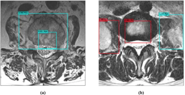 Figure 4.  Two examples of probability measurements within each image. (a) A 72-year-old woman with  pyogenic spondylitis