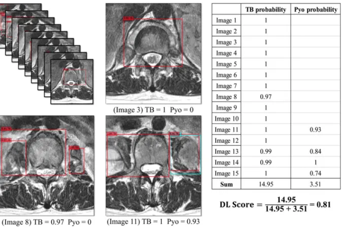 Figure 5.  An example of deep-learning scoring in a 30-year-old woman with tuberculous spondylitis patients