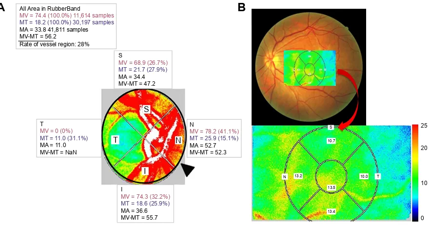 Figure 1 The mean blur rate (MBR) displayed as a 2D color-coded map. (A) MBR at the disc as the retinal blood flow, which was calculated automatically after circling the margin of the optic disc with a rubber band ()