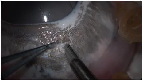 Figure 6 8K UHD image in creating a sclera flap of pig cadaver eye.Abbreviation: UHD, ultra-high-definition.