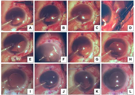 Figure 1 steps of our 27-gauge needle-assisted externalization and haptic securing technique.Notes: (A) Labeling 2mm from limbus-180 degree apart