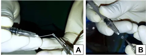Figure 2 3D – steps of our 27-gauge needle-assisted externalization and haptic securing technique.Notes: (A) entry of the 27G needle aiming mid vitreous