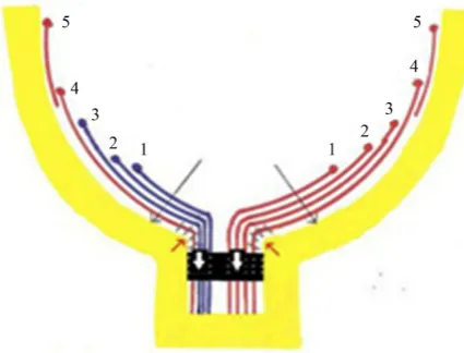 Figure 3. Note the sinking of the disc resulting in stretching and severing of the peripheral fibers