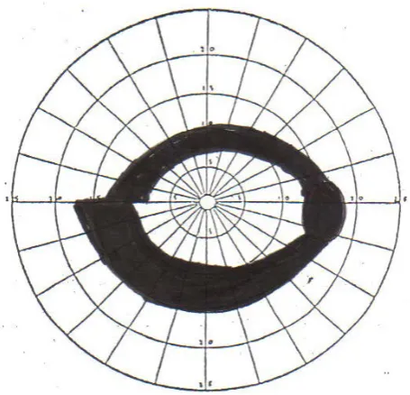 Figure 4. Due to temporal sinking all the temporal fibers (Macular, superior and inferior arcuate) are being axotomized