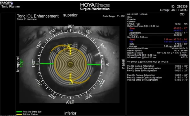 Figure 2 Postoperative assessment of toric iOl alignment with ray tracing aberrometer in a case in group ii (image-guided surgery)