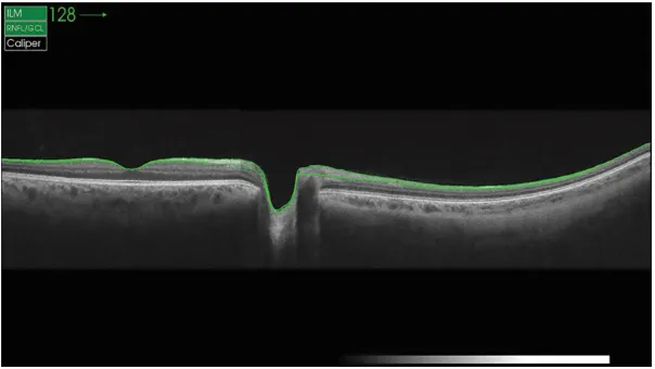 Figure 1 Retinal images were acquired using the swept-source Deep Range Imaging-OCT (DRI-OCT-1, Topcon, Tokyo, Japan).field, including up to 10 mm nasal and 8 mm temporal to the optic disc, and 3 mm superior and inferior to the optic disc.Note: Montaging the routine wide-angle OCT image with the nasal peripheral OCT image (acquired with a contralateral gaze) yielded the composite image with a larger Abbreviation: OCT, optical coherence tomography.