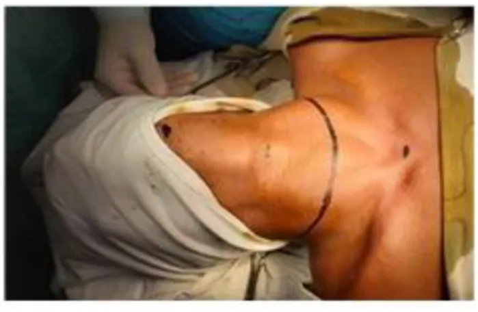 Figure 1: Incision mark. 