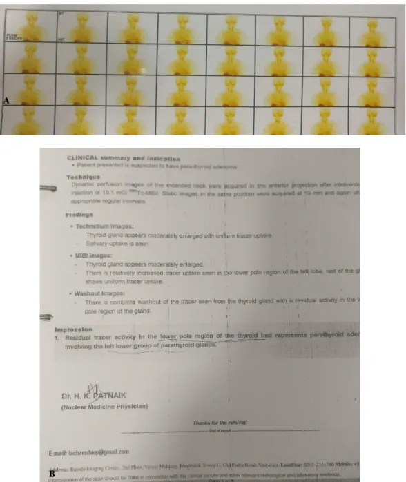 Figure 1: (A) Sestamibi scan showing increased tracer uptake in lower pole region of left lobe of thyroid                          gland and (B) report of 99m Tc- MIBI