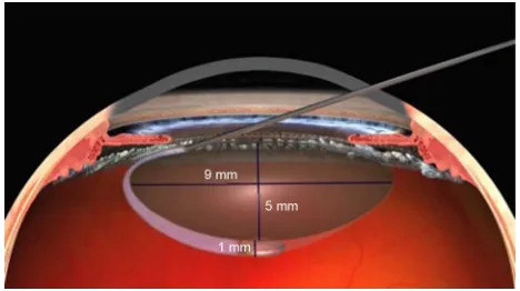 Figure 1 the height of the liquid column formed in front of the posterior capsule of 0.1 cc liquid for hydrodissection.